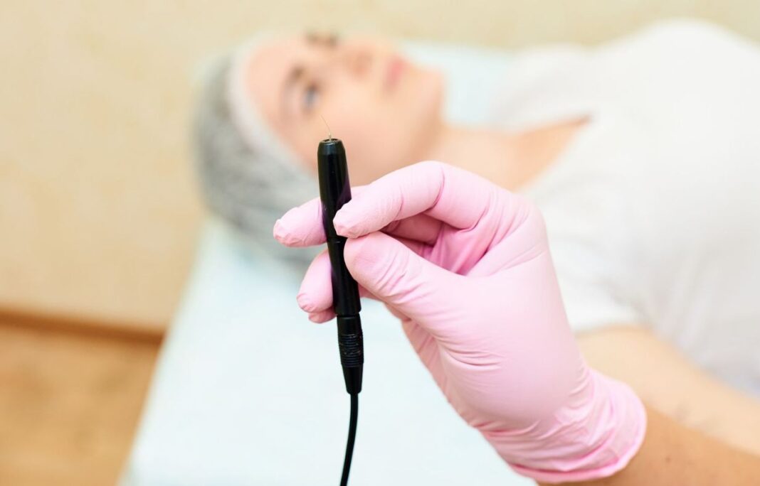 How Much Does Electrolysis Hair Removal Cost?