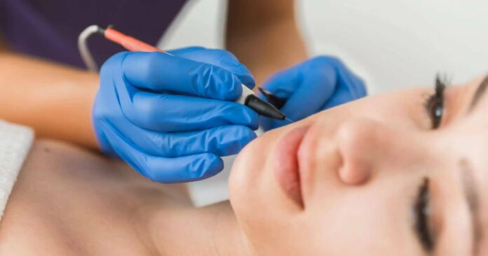 Electrolysis Hair Removal Tips and Tricks: Pre and Post-Care for Best Results