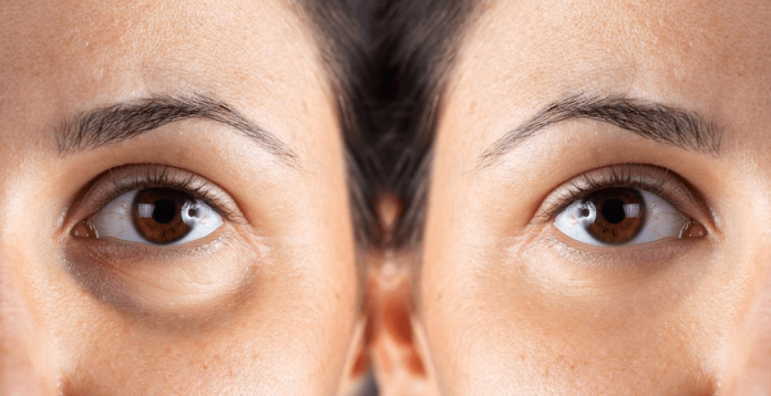 How Do You Get Bags Under Your Eyes? 9 Causes and 10 Treat Ways