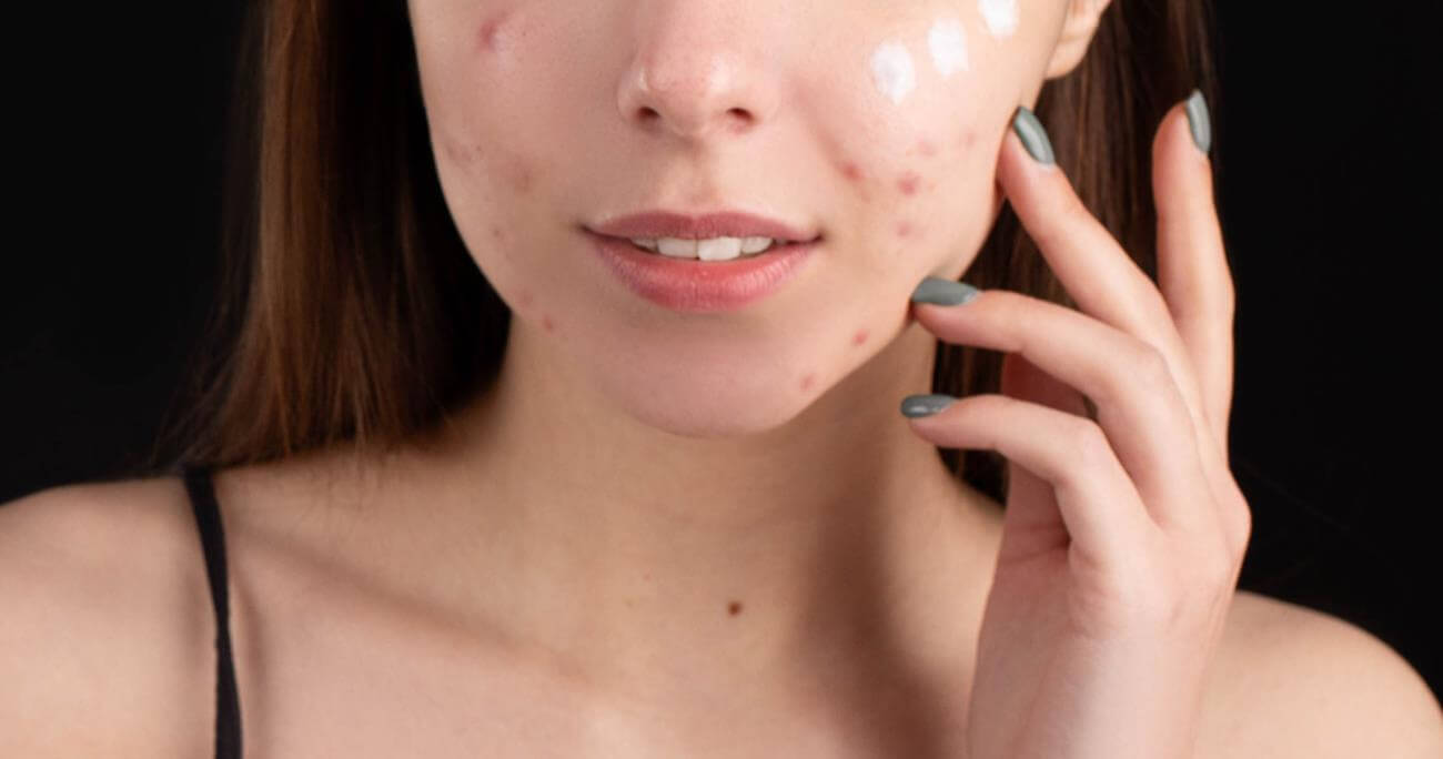 Acne Before Period: Causes, Types, and How to Treatment