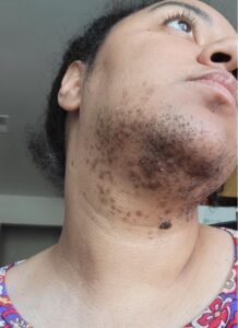 Chin Hair a Sign of PCOS