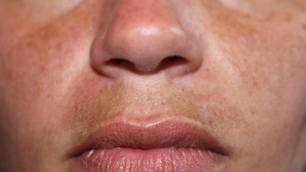 How to Get Rid of Mustache Shadow Easy Methods & Tips