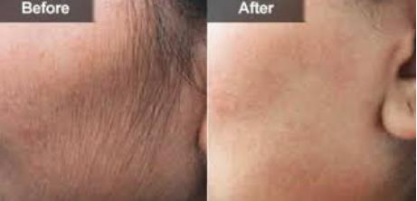 Laser Hair Removal Face Before and After