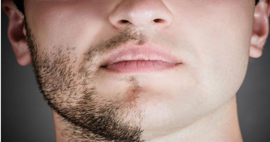 Laser Hair Removal Face Men