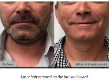 Laser Hair Removal Men’s Face Before and Afte