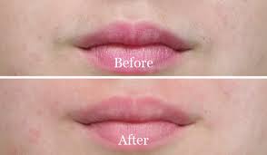 Waxing Upper Lip Bad for Skin