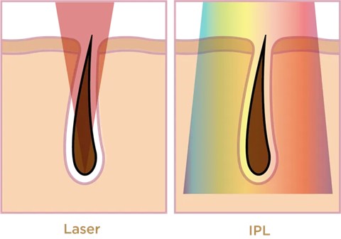What is IPL Hair Removal IPL Vs. Laser