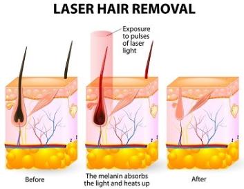 What is IPL Hair Removal