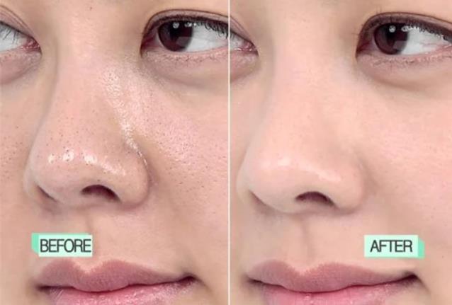 Can You Get Rid of Pores Completely
