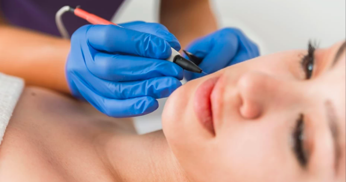 Is Electrolysis Hair Removal Permanent? (& FAQs)