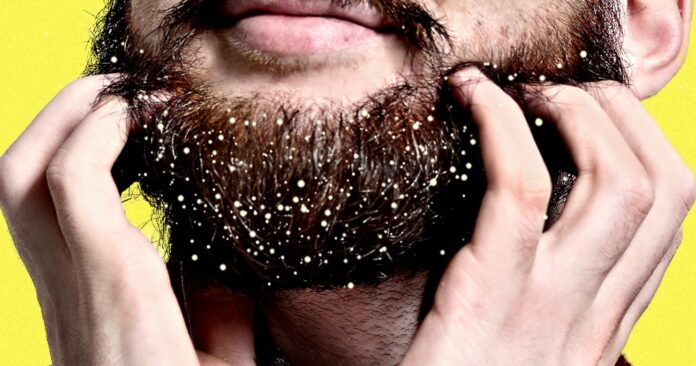 How to Get Rid of Beard Dandruff?