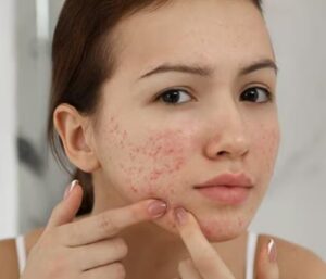 If your skin is prone to breakouts, acne, or pimples