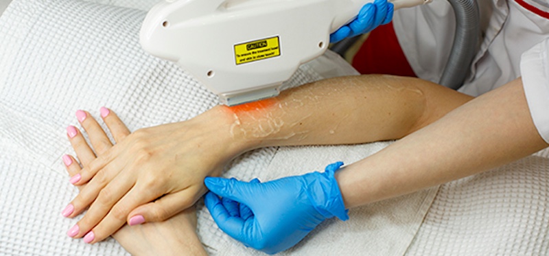 Laser Hair Removal