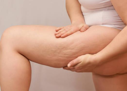 Treating and Preventing Cellulite