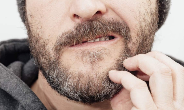 What is Beard Dandruff