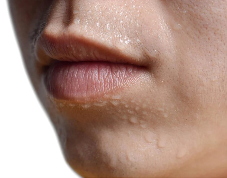 how to stop upper lip sweat 