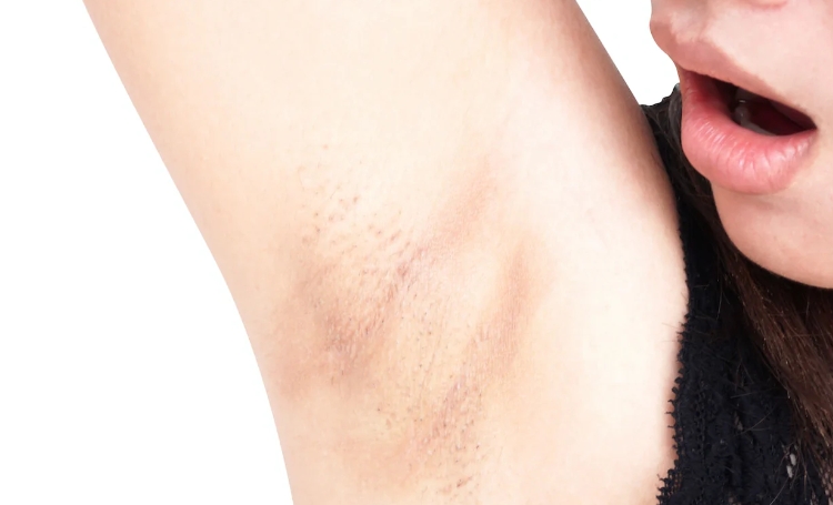 Irritation From Shaving, Friction, or Excessive Sweating