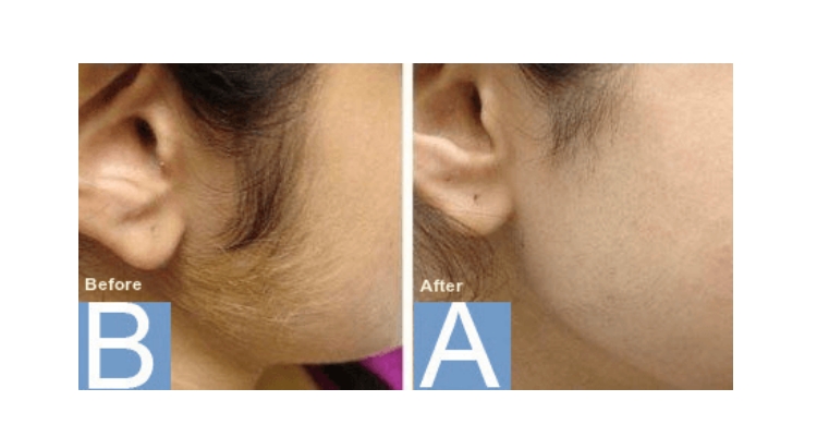 Before and After Results of Yag Laser Hair Removal