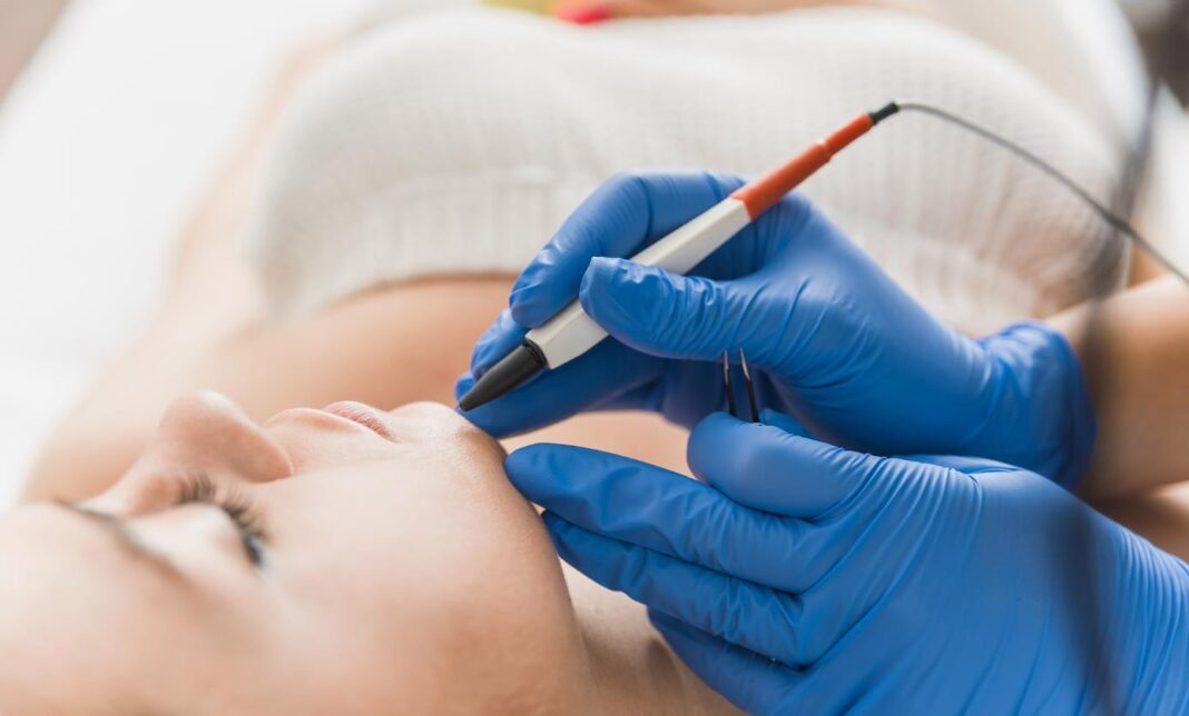 Does Electrolysis Hair Removal Hurt