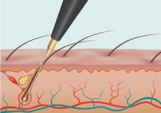 How Does Electrolysis Work