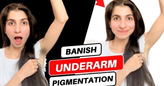 How to Get Rid of Underarm Hyperpigmentation? | Dr. Sanober Doctor