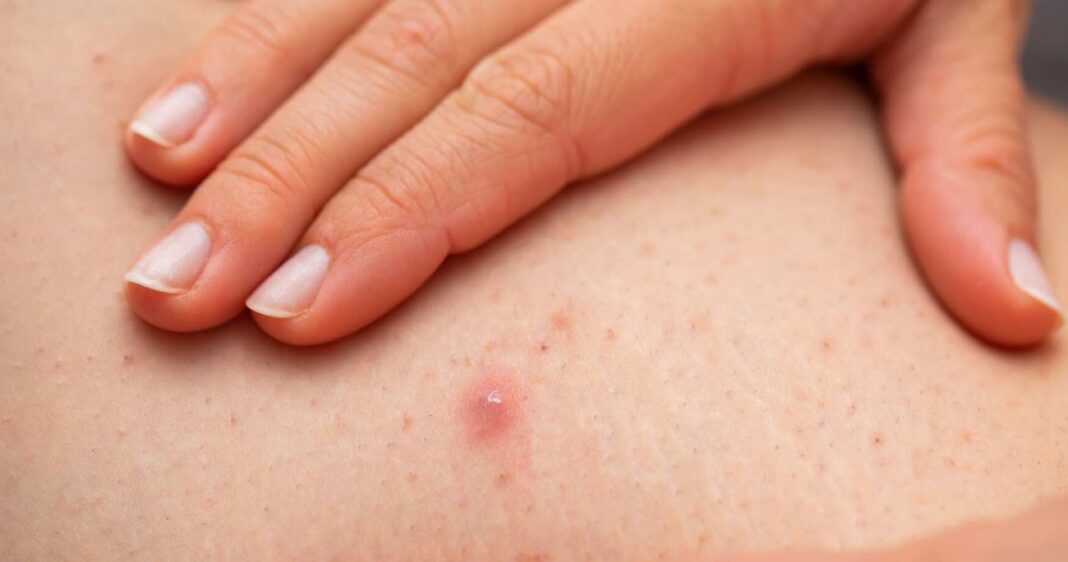 How to Treat and Prevent Folliculitis After Waxing