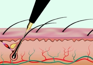 Types of Electrolysis Hair Removal
