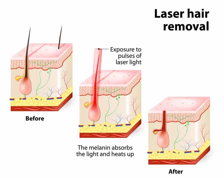 Laser Hair Removal: How Does it Work?