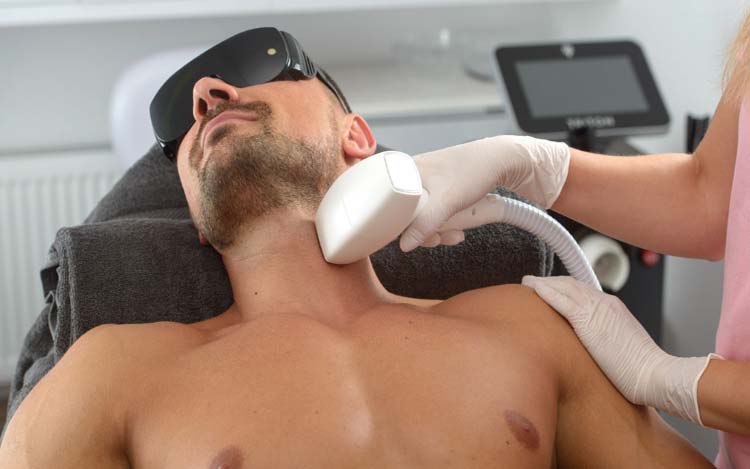 The Laser Hair Removal Process for Beard