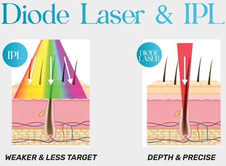 Diode Laser Hair Removal vs. IPL