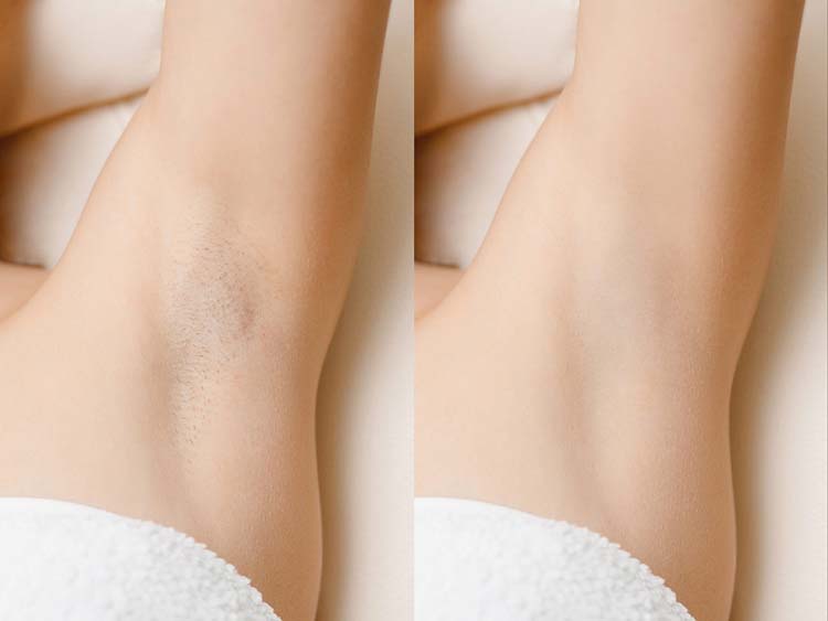 Armpit-Laser-Hair-Removal-Before-After