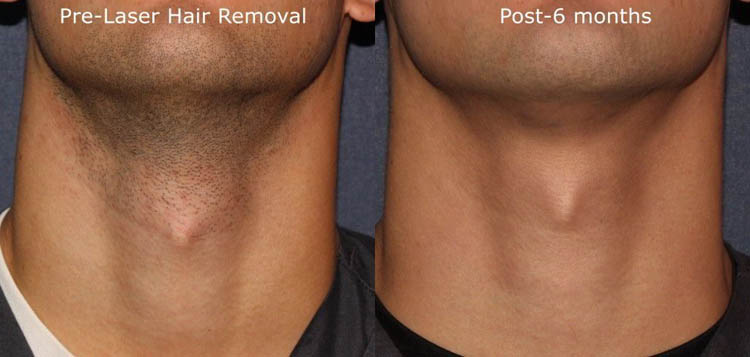 Can I Grow My Beard After Laser Hair Removal