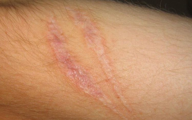 Does Laser Hair Removal Leave Scars
