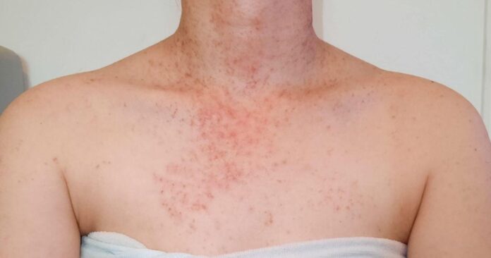 How to Treat Folliculitis After Laser Hair Removal Treatment？