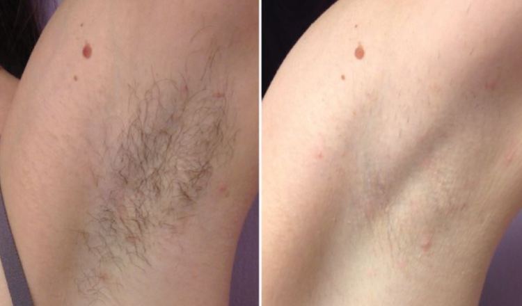 How to Get Rid of Scars From Laser Hair Removal