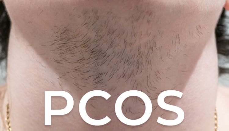 What’s PCOS?