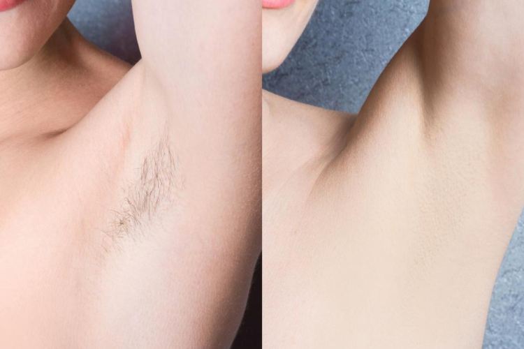 Waxing vs. Laser Hair Removal Effectiveness and Long-Term Results