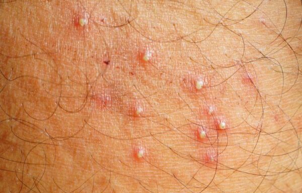 How to Treat Folliculitis After Laser Hair Removal Treatment - Ulike