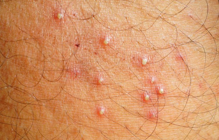 When to Seek Medical Help in Folliculitis After Laser Hair Removal