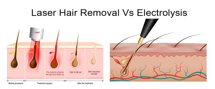 Laser Hair Removal Vs. Electrolysis