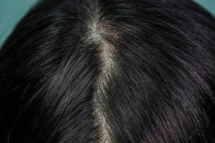 How To Get Rid Of Pili Multigemini
