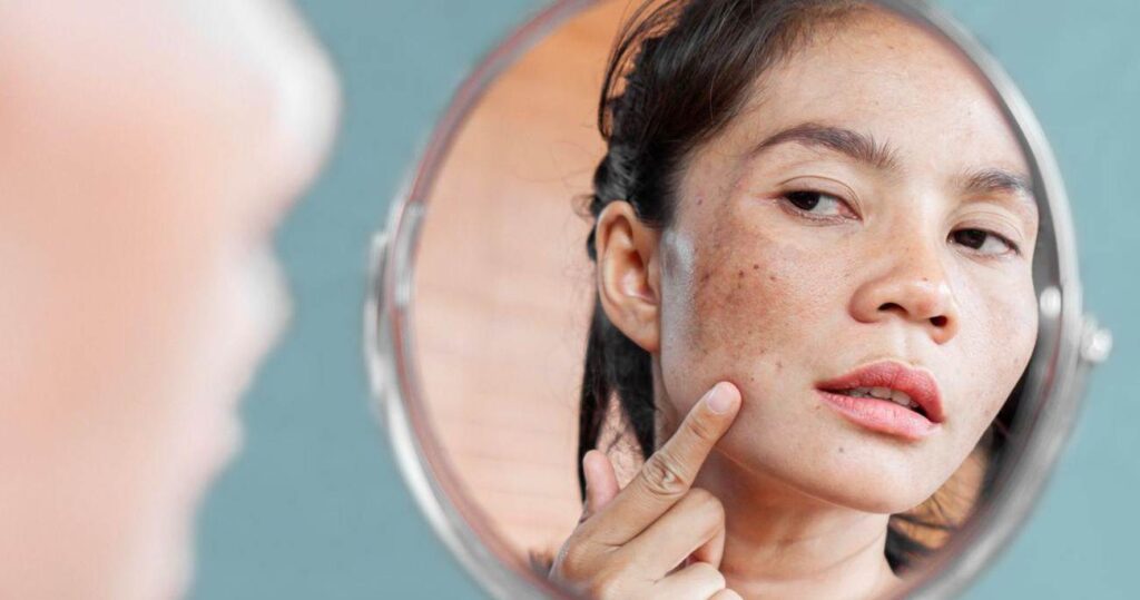 How to Treat and Prevent Hyperpigmentation From Laser Hair Removal? Ulike