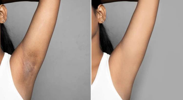Lifestyle and Hygiene Practices for Lightening Dark Armpits