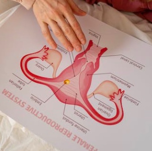 Ovarian Disorders