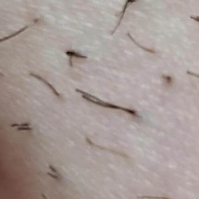 "Understanding Pili Multigemini Causes, Risk Factors, and Effective Treatments" Ulike Blog