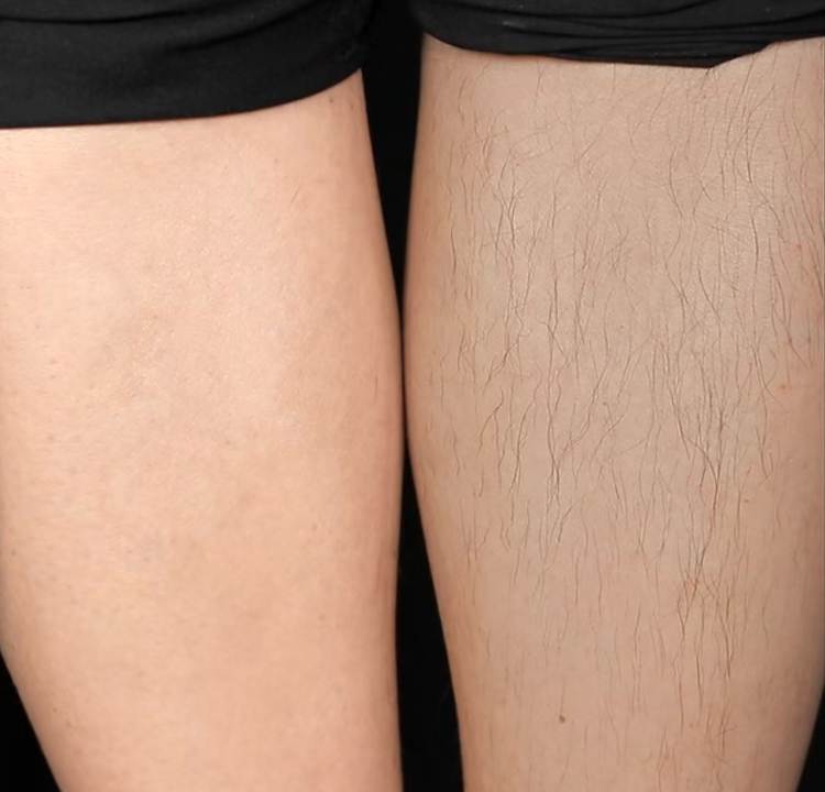 Why Do Some Females Grow Body Hair