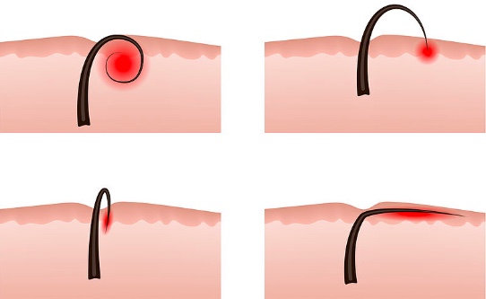 What are the Compatible and Incompatible Areas with Plucking?