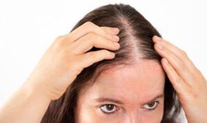 Can Women Suffer from Baldness?