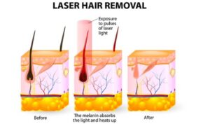 What is the Working Mechanism of Laser Hair Removal?