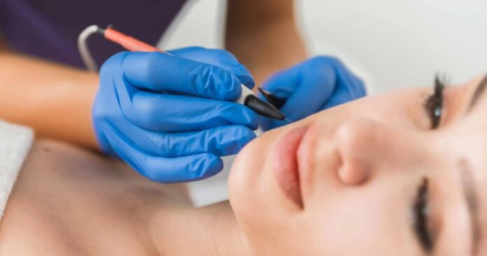 8 Questions You Should Know Before Electrolysis Chin Hair